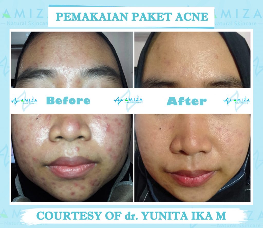 skin care semarang, jual skin care semarang, jual skincare di semarang, skincare di semarang, jual skincare murah semarang, skincare murah aman semarang, skincare terpercaya dan aman, skincare bpom dan halal, skincare halal semarang, skincare halal dan aman, skincare tanpa efek samping, jual skincare glowing, merk skincare yang aman untuk kulit, jual skincare Kendal, produk skincare Kendal, harga skincare amiza, harga paket skincare amiza, paket skincare terlengkap, paket skincare terbaik, Paket Skincare terbaik BPOM, paket skincare glowing, paket skincare untuk kulit glowing, skincare murah kaliwungu, skincare kaliwungu, produk lokal skincare terbaik, brand skincare semarang, brand skincare terbaik Indonesia, brand skincare terbaik halal, merk skincare terbaik Indonesia, daftar harga paket skincare, paket skincare murah, paket skincare murah dan aman, paket skincare murah semarang, paket skincare acne murah, rekomendasi skincare lokal, rekomendasi skincare semarang, rekomendasi skincare murah dan aman, rekomendasi skincare aman dan halal, daftar paket skincare murah, skincare murah berkualitas, Merk skincare lokal terbaik, skincare semarang murah, produk skincare murah dan aman, produk skincare teruji bpom, produk skincare bersertifikat bpom, skincare bersertifikat bpom, daftar skincare bpom untuk glowing, skincare lokal bpom, paket skincare murah terbaik, skincare murah aman berkualitas