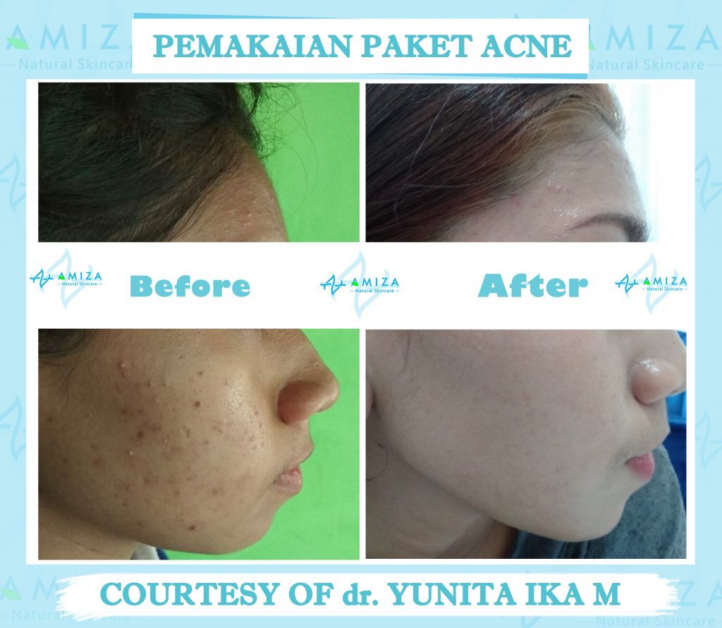 skin care semarang, jual skin care semarang, jual skincare di semarang, skincare di semarang, jual skincare murah semarang, skincare murah aman semarang, skincare terpercaya dan aman, skincare bpom dan halal, skincare halal semarang, skincare halal dan aman, skincare tanpa efek samping, jual skincare glowing, merk skincare yang aman untuk kulit, jual skincare Kendal, produk skincare Kendal, harga skincare amiza, harga paket skincare amiza, paket skincare terlengkap, paket skincare terbaik, Paket Skincare terbaik BPOM, paket skincare glowing, paket skincare untuk kulit glowing, skincare murah kaliwungu, skincare kaliwungu, produk lokal skincare terbaik, brand skincare semarang, brand skincare terbaik Indonesia, brand skincare terbaik halal, merk skincare terbaik Indonesia, daftar harga paket skincare, paket skincare murah, paket skincare murah dan aman, paket skincare murah semarang, paket skincare acne murah, rekomendasi skincare lokal, rekomendasi skincare semarang, rekomendasi skincare murah dan aman, rekomendasi skincare aman dan halal, daftar paket skincare murah, skincare murah berkualitas, Merk skincare lokal terbaik, skincare semarang murah, produk skincare murah dan aman, produk skincare teruji bpom, produk skincare bersertifikat bpom, skincare bersertifikat bpom, daftar skincare bpom untuk glowing, skincare lokal bpom, paket skincare murah terbaik, skincare murah aman berkualitas