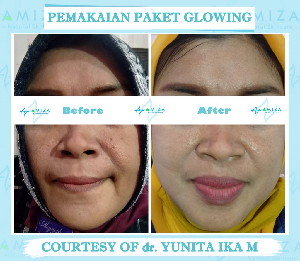 skin care semarang, jual skin care semarang, jual skincare di semarang, skincare di semarang, jual skincare murah semarang, skincare murah aman semarang, skincare terpercaya dan aman, skincare bpom dan halal, skincare halal semarang, skincare halal dan aman, skincare tanpa efek samping, jual skincare glowing, merk skincare yang aman untuk kulit, jual skincare Kendal, produk skincare Kendal, harga skincare amiza, harga paket skincare amiza, paket skincare terlengkap, paket skincare terbaik, Paket Skincare terbaik BPOM, paket skincare glowing, paket skincare untuk kulit glowing, skincare murah kaliwungu, skincare kaliwungu, produk lokal skincare terbaik, brand skincare semarang, brand skincare terbaik Indonesia, brand skincare terbaik halal, merk skincare terbaik Indonesia, daftar harga paket skincare, paket skincare murah, paket skincare murah dan aman, paket skincare murah semarang, paket skincare acne murah, rekomendasi skincare lokal, rekomendasi skincare semarang, rekomendasi skincare murah dan aman, rekomendasi skincare aman dan halal, daftar paket skincare murah, skincare murah berkualitas, Merk skincare lokal terbaik, skincare semarang murah, produk skincare murah dan aman, produk skincare teruji bpom, produk skincare bersertifikat bpom, skincare bersertifikat bpom, daftar skincare bpom untuk glowing, skincare lokal bpom, paket skincare murah terbaik, skincare murah aman berkualitas