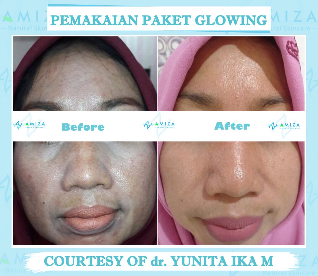 skin care semarang, jual skin care semarang, jual skincare di semarang, skincare di semarang, jual skincare murah semarang, skincare murah aman semarang, skincare terpercaya dan aman, skincare bpom dan halal, skincare halal semarang, skincare halal dan aman, skincare tanpa efek samping, jual skincare glowing, merk skincare yang aman untuk kulit, jual skincare Kendal, produk skincare Kendal, harga skincare amiza, harga paket skincare amiza, paket skincare terlengkap, paket skincare terbaik, Paket Skincare terbaik BPOM, paket skincare glowing, paket skincare untuk kulit glowing, skincare murah kaliwungu, skincare kaliwungu, produk lokal skincare terbaik, brand skincare semarang, brand skincare terbaik Indonesia, brand skincare terbaik halal, merk skincare terbaik Indonesia, daftar harga paket skincare, paket skincare murah, paket skincare murah dan aman, paket skincare murah semarang, paket skincare acne murah, rekomendasi skincare lokal, rekomendasi skincare semarang, rekomendasi skincare murah dan aman, rekomendasi skincare aman dan halal, daftar paket skincare murah, skincare murah berkualitas, Merk skincare lokal terbaik, skincare semarang murah, produk skincare murah dan aman, produk skincare teruji bpom, produk skincare bersertifikat bpom, skincare bersertifikat bpom, daftar skincare bpom untuk glowing, skincare lokal bpom, paket skincare murah terbaik, skincare murah aman berkualitas